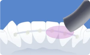 Boutique spécialisée en contentions orthodontiques