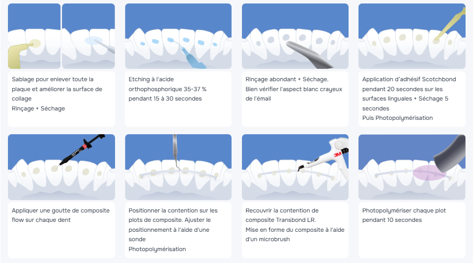 Pose d'un fil de contention nouvelle génération eZtain
